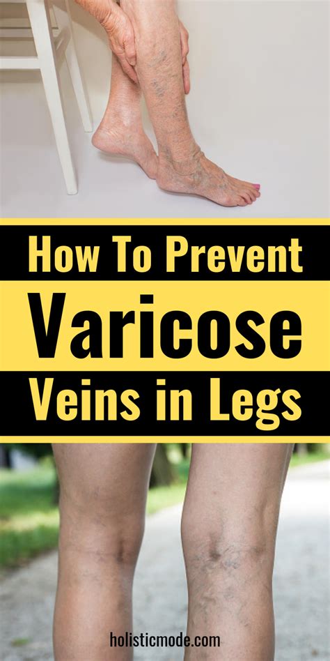 Pin On Varicose Veins Treatment How To Get Rid Of