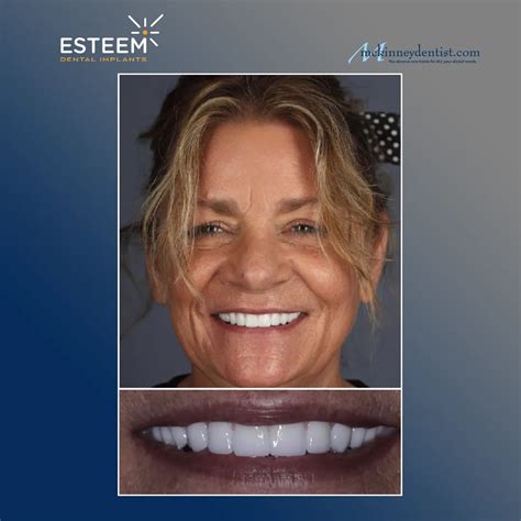 Esteem Dental Implants Boulder County Smiles Dental Implant Options