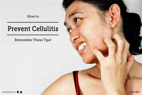 How To Prevent Cellulitis Remember These Tips By Dr Vsethu Raman