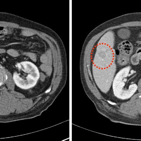 Figure1abdominal Computed Tomography Showed A 16 Cm Sized Lesion In