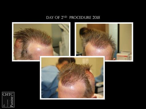 Panine Md Chicago Hair Transplant Clinic Two Procedures Fut