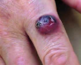 Merkel cell carcinoma (mcc) is a rare, aggressive form of skin cancer with a high risk for returning (recurring) and spreading (metastasizing), often within two to three years after initial diagnosis. Avelumab (Bavencio) approved to treat Merkel Cell ...