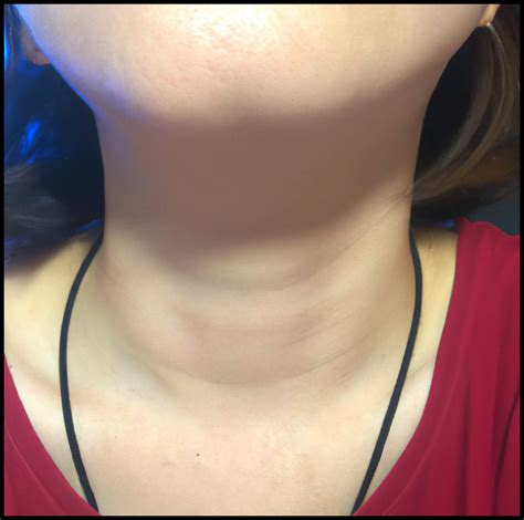 Can Seasonal Allergies Cause Swollen Lymph Nodes In Neck Womens
