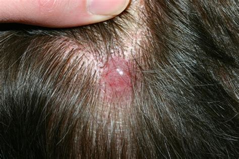 Basal Cell Skin Cancer On Scalp