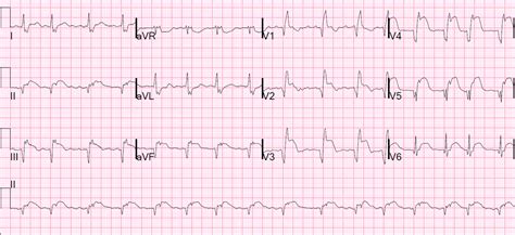 Dr Smiths Ecg Blog Subacute Anteroseptal Stemi With Persistent St