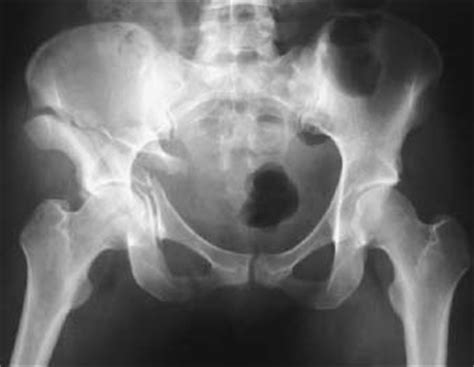 82 Acetabular Fractures Radiology Key