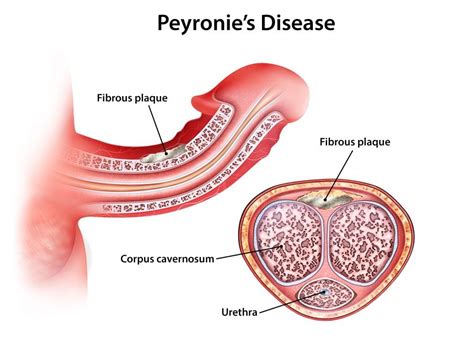 Peyronies Treatment Private Erectile Dysfunction Clinic Contact Us Today For Ed Help