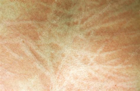 Dermatographic Urticaria Stock Image C0222143 Science Photo Library