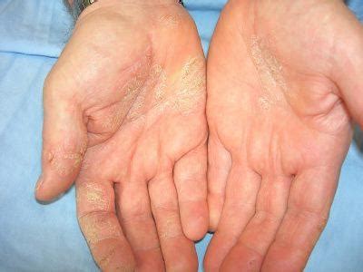 Dermatitis Na Rukama Vrste I Metode Lije Enja Slo Enih Bolesti