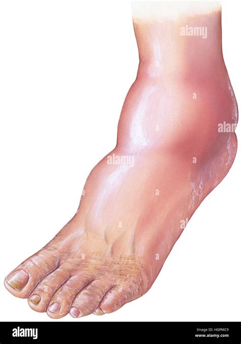 Is Swelling Of The Feet A Sign Of Diabetes