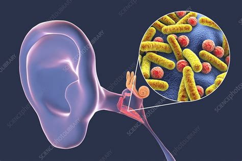 Otitis Media Ear Infection Illustration Stock Image F0325969
