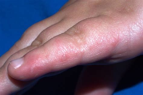 Hand Foot And Mouth Disease Nhs
