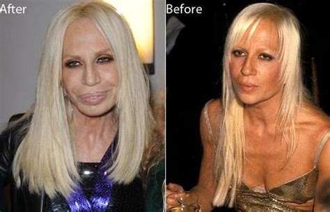 Donatella Versace After And Before Plastic Surgery Celebrity Plastic Surgery Online