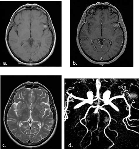 Figure 4 From Distal Middle Cerebral Artery Dissection With Concurrent
