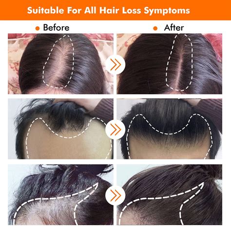 Erdkunde H Fte Emotional Derma Roller Hair Results Before And After Aal