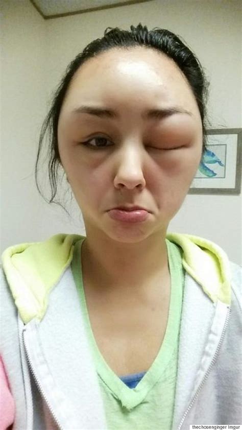 Shocking Photos Show Womans Ballooning Face After Allergic Reaction To