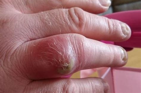 Dad Receives Emergency Operation For Horror Wound After Spider Bit Him
