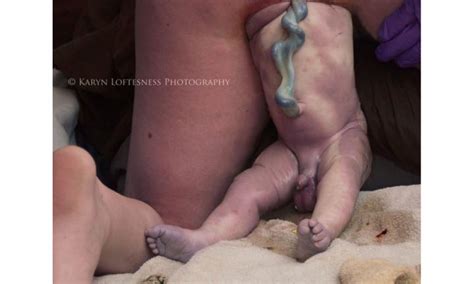 Amazing Breech Birth Photos
