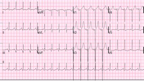 Dr Smiths Ecg Blog St Elevation And Positive Troponin Is It Stemi