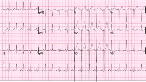 Dr. Smith's ECG Blog: January 2014