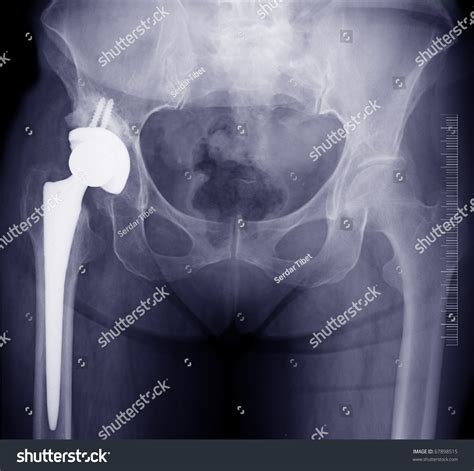 Hip Replacement X Ray Stock Photo 67898515 Shutterstock