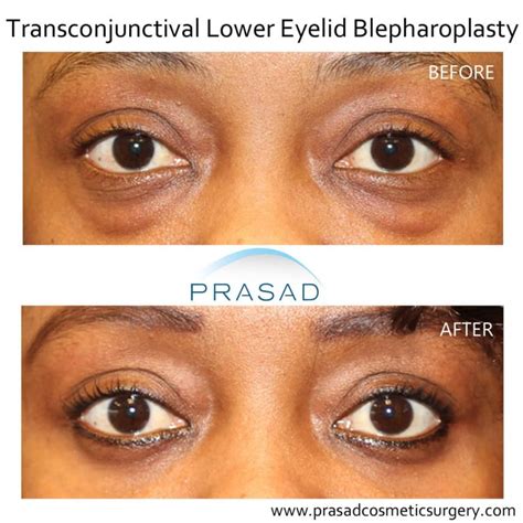 Lower Blepharoplasty Recovery Process Dr Prasad Blog