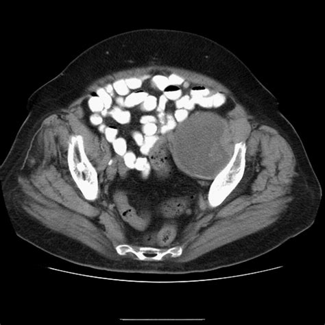 Pseudotumor Presenting As A Pelvic Mass A Complication Of Eccentric