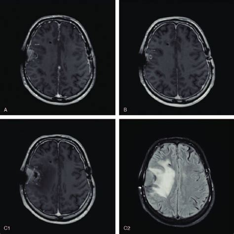 Axial Post Contrast T1 Weighted Magnetic Resonance Imaging Showing