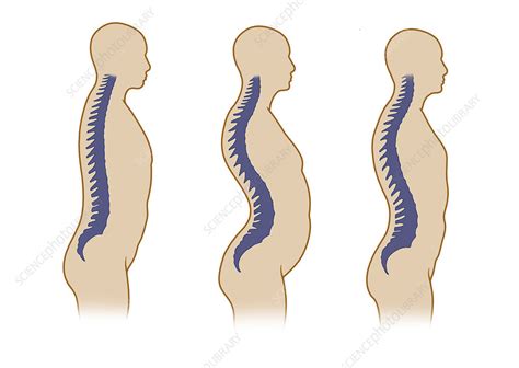 Spinal Curvatures Stock Image C001 5018 Science Photo Library