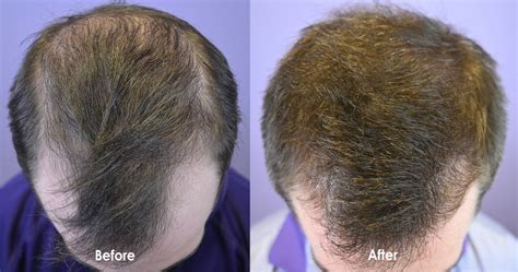Low Dose Minoxidil Pill Prescribed For Early Hair Loss Hair Restoration Of The South