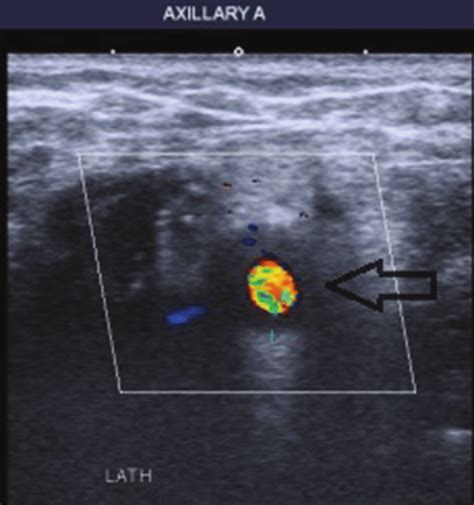 Halo Sign On Axillary Artery Ultrasound Download Scientific Diagram