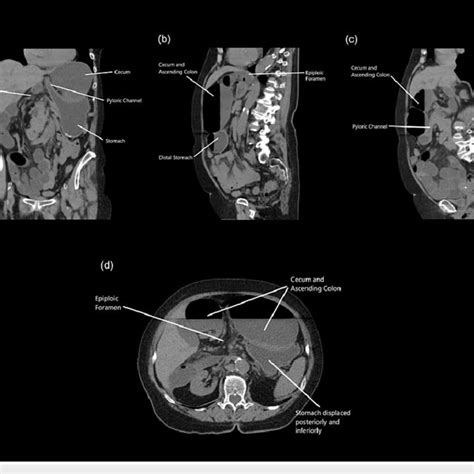 Ct Abdomen And Pelvis Without Contrast Whirl Sign Displaying Cecal