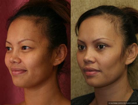 Strenuous activity should be avoided for at least four to six weeks. Patient #9891 Asian Eyelid Surgery (Blepharoplasty) Before and After Photos Encino - Plastic ...