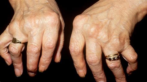 The 4 Stages Of Rheumatoid Arthritis And Affects Businessinmyarea