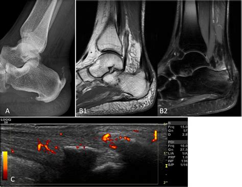 Achilles Tendon Enthesitis Of The Same Patients With Peripheral Spa As