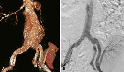 Open And Endovascular Repair Of Abdominal Aortic Aneurysms In Kidney