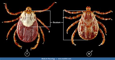 Tick Paralysis Medlink Neurology