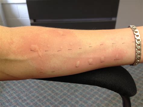 Allergy Test Results Food Allergy Parent
