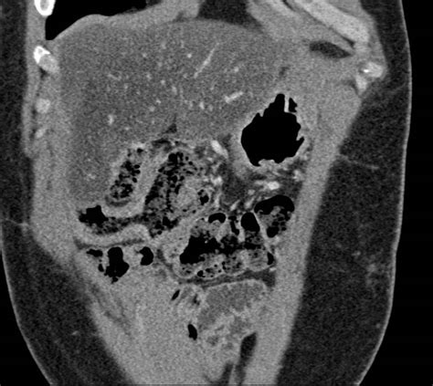 Diffuse Fatty Infiltration Of The Liver Liver Case Studies Ctisus