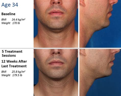 Pin On Kybella Before And After Photos For Double Chin