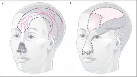 Median Forehead Flap With Soft Tissue Expansion Facial Plastic Surgery