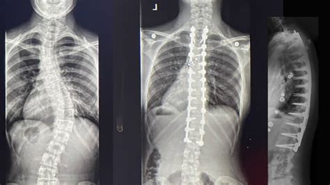 Anna Browning Scoliosis Patient Story Cleveland Clinic