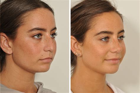 Top Celebrity Rhinoplasty Surgeon Natural Looking Nose Job Surgery For