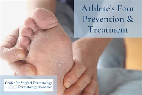 A Dermatologists Game Plan For Preventing And Treating Athletes Foot