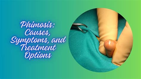 Understanding Phimosis Causes Symptoms And Treatment Options