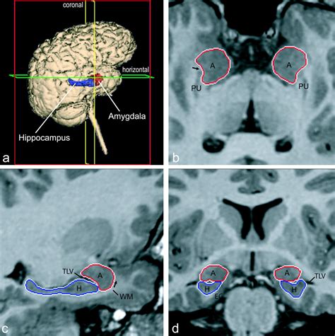The Amygdala Is Enlarged In Children But Not Adolescents With Autism