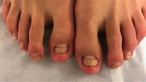 Woman Lost Her Toenails After Fish Pedicure