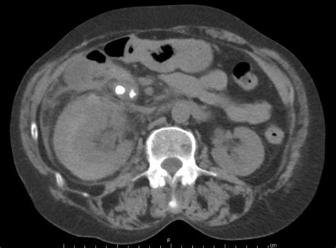 Post Eswl Ct Scan Revealing A Moderate Right Sided Perinephric Hematoma