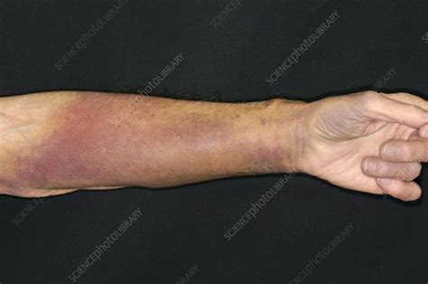 Bruised Warfarin Patients Arm Stock Image M3301723 Science
