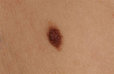 How To Spot Cancerous Moles Cleveland Clinic